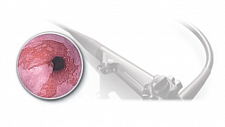 Пищевод Барретта. Методические рекомендации Рэндо