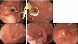 Синдром скрытого бампера buried bumper syndrome ("Бампер - синдром"): осложнение чрескожной эндоскопической гастростомии