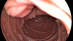 Аденома БДС