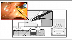 Диссертация З.В. Галкова БАЛЛОННАЯ ПАПИЛЛОДИЛАТАЦИЯ 2002