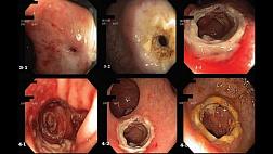 Эндоскопическое лечение рубцовых стриктур межкишечных анастомозов