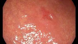 Перстневидноклеточный рак желудка.