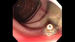 ЭРХПГ. Печеночная двуустка  (Fasciola hepatica)