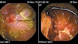 МЕСТО ВИДЕОКАПСУЛЬНОЙ ЭНДОСКОПИИ В АЛГОРИТМЕ ДИАГНОСТИКИ БОЛЕЗНИ КРОНА ТОНКОЙ КИШКИ