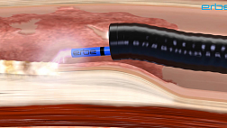 ВСТРЕЧАЙТЕ! "ЭЛЕКТРОХИРУРГИЯ" - Новый раздел на EndoExpert.ru