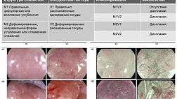 Классификация патологических изменений при пищеводе Барретта (ZEEBO)