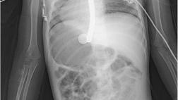 ПИЩЕВОДНО-АОРТАЛЬНАЯ ФИСТУЛА ПОСЛЕ ГЛОТАНИЯ БАТАРЕЙКИ