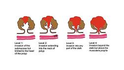 Классификация по Хаггитт (Haggitt) малигнизированных полипов ободочной кишки. Стадирование по Кикучи (Kikuchi) раннего рака ободочной кишки