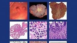 Классификация опухолей желудочно-кишечного тракта ВОЗ 2019, пятое издание.