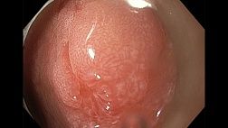 Нейроэндокринная опухоль антрального отдела желудка. Эндоскопическая резекция с диссекцией в подслизистом слое.