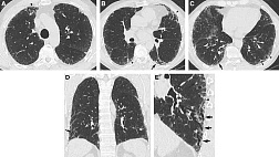 Идиопатический легочный фиброз: новые международные клинические рекомендации