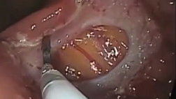 История и интересные факты об оперативном лечении на толстой кишке.