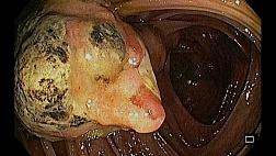 липома Баугиниевой заслонки