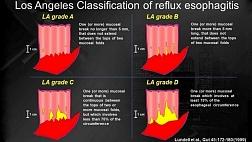 Лос-Анжелесская классификация рефлюкс-эзофагита. LA Classification