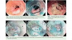 Клиническое наблюдение: аденома терминального отдела подвздошной кишки и ее удаление методом ESD