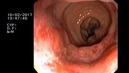 Эндоскопическая картина после ректального введения 2 мл раствора перекиси водорода H2О2