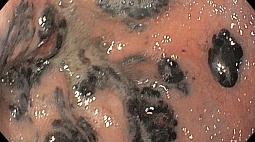 Метастаз пигментной меланомы в ЖКТ (ротовую полость, гортань, кардию, желудок, ДПК).