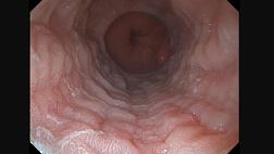 Клиническое наблюдение эозинофильного эзофагита (ЭоЭ) E1R0E1F2S0