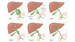 Классификация врожденных кист желчевыводящих путей по Todani