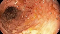 Язвенный колит/ Ulcerative  Colitis. Шкала UCEIS