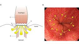 Киотский международный консенсус по пищеводу Барретта, Gut 2022;71:1488-1514. Перевод.