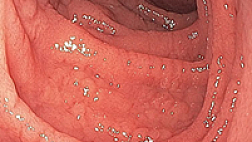Всероссийский консенсус по диагностике и лечению целиакии у детей и взрослых 2017