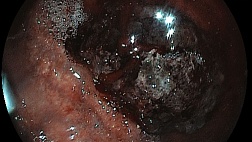 Метастаз меланомы в желудок