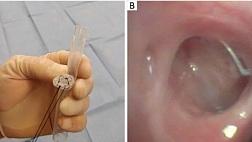 БРОНХОПЛЕВРАЛЬНЫЙ СВИЩ