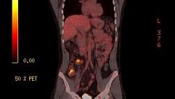 ГЕРМИНОГЕННАЯ ОПУХОЛЬ ТОЛСТОЙ КИШКИ