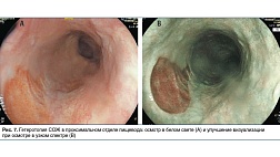 Гетеротопия слизистой оболочки желудка в проксимальном отделе пищевода: исторический ракурс и современный взгляд