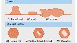 Эндоскопический спектр и практическая классификация стромальных опухолей тонкой кишки желудочно-кишечного тракта (ГИСО), обнаруженных при двухбаллонной энтероскопии
