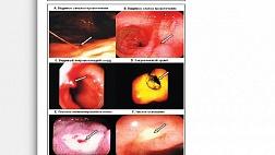 Лечение острого язвенного кровотечения