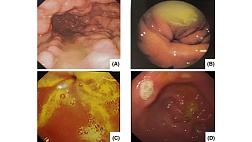 Перевод. Взаимосвязь между раком желудка, его предраковыми изменениями  и желчным рефлюксом: ретроспективное исследование. 