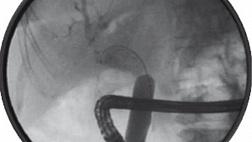 Синдром Мириззи: клинический случай