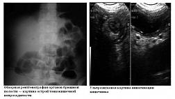 Острая тонкокишечная непроходимость, вызванная эктопированным участком поджелудочной железы. Клинический случай 