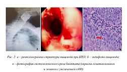 Красный плоский лишай как одна из причин образованиястриктуры пищевода – клиника, диагностика и подходы к лечению в многопрофильном стационаре