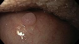 Папиллома ротоглотки