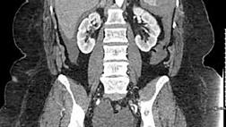 ПОВРЕЖДЕНИЕ СЕЛЕЗЕНКИ КАК ОСЛОЖНЕНИЕ ПОСЛЕ КОЛОНОСКОПИИ 