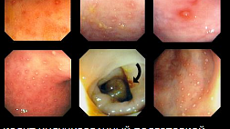 Индуцированные подготовкой колиты
