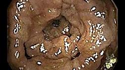 ИДИОПАТИЧЕСКИЕ ВАРИКСЫ