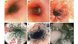 Классификация Заргар (Zargar classification) - оценка повреждения пищевода при проглатывании едких (каустических) веществ