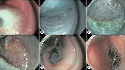 ЖЕЛУДОЧНАЯ ПЕРОРАЛЬНАЯ ЭНДОСКОПИЧЕСКАЯ МИОТОМИЯ (G-POEM): ПОКАЗАНИЯ, ТЕХНИКА ВЫПОЛНЕНИЯ, РЕЗУЛЬТАТЫ