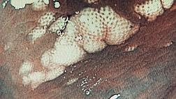 Липоматоз толстой кишки