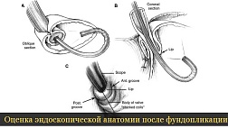 Оценка эндоскопической анатомии после фундопликации.
