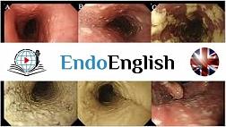 Esophageal Candidiasis. МЕДИЦИНСКИЙ АНГЛИЙСКИЙ
