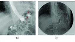 ЖЕЛУДОЧНО-ПЛЕВРАЛЬНЫЙ СВИЩ