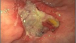 Перфорация пищевода при раке желудка