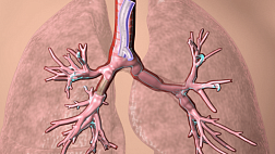 FDA одобрило изготовление индивидуально стентов для дыхательных путей с помощью 3D-печати