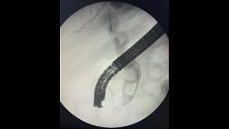 Ретроградная холангиопанкреатография при юкстадивертикулярном расположении большого дуоденального сосочка.
