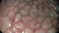 “Cobblestone esophagitis” (эзофагит со слизистой булыжной мостовой)